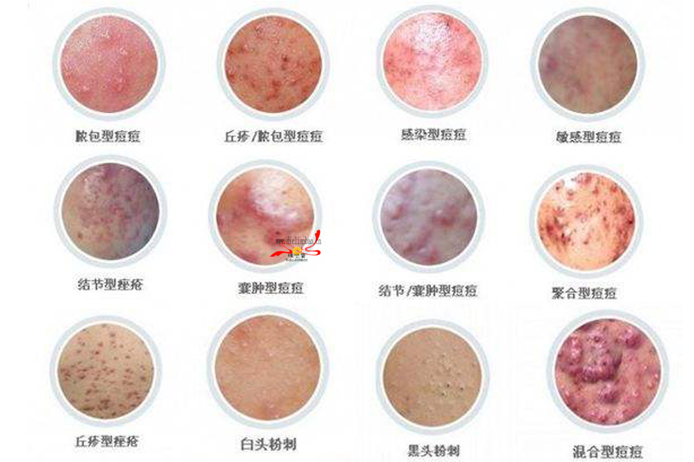 少数患者面部出油治愈后如何修复? - 西安市高陵区吉兆春皮肤诊所