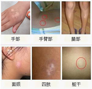 白癜风治愈后有少数复发,正常吗?