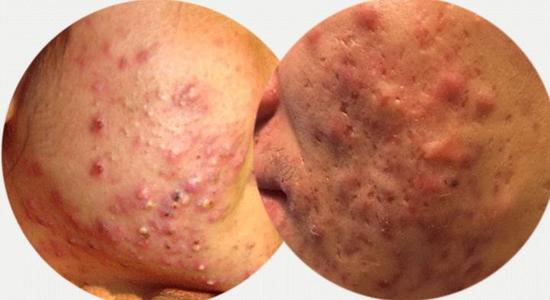 九大类型青春痘痤疮一招搞定