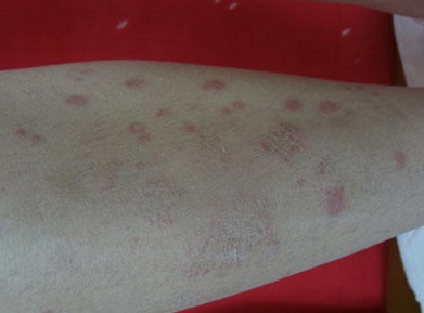 好发于躯干和四肢近端大小不等,数目不定玫瑰色斑片,其上有糖状鳞屑