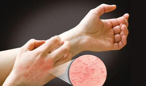 诊断接触性皮炎