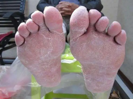 手癣脚癣怎么治