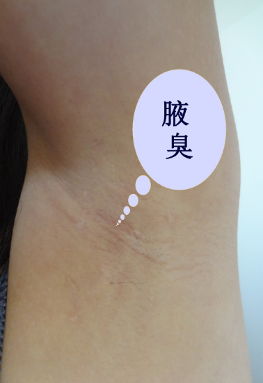 如何解决狐臭的问题